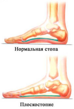 Позаботьтесь о стопах.jpg