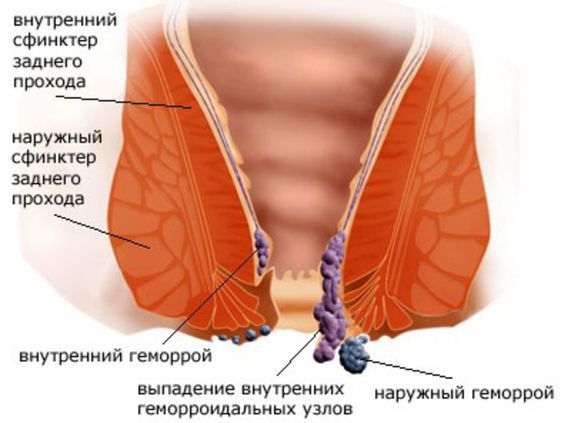 Как Выглядит Геморрой Фото