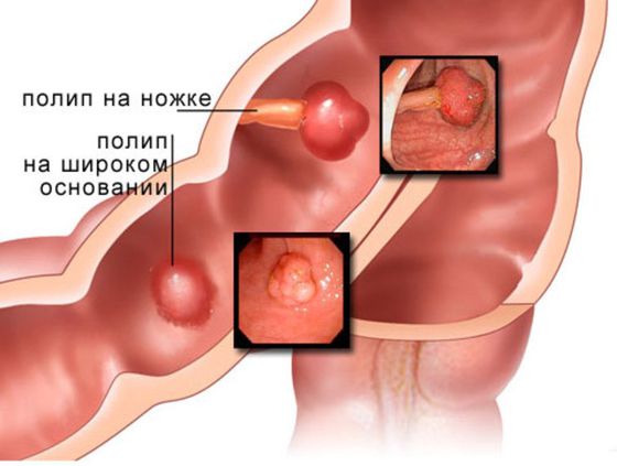 Полипы толстой кишки.jpg